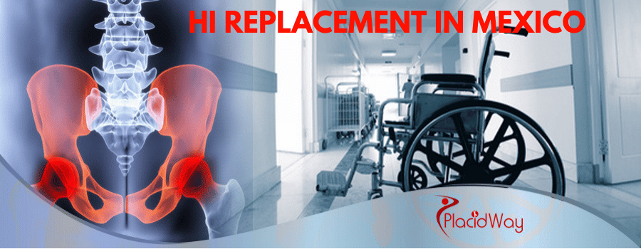 Check out Popular Packages for Hip Replacement in Mexico
